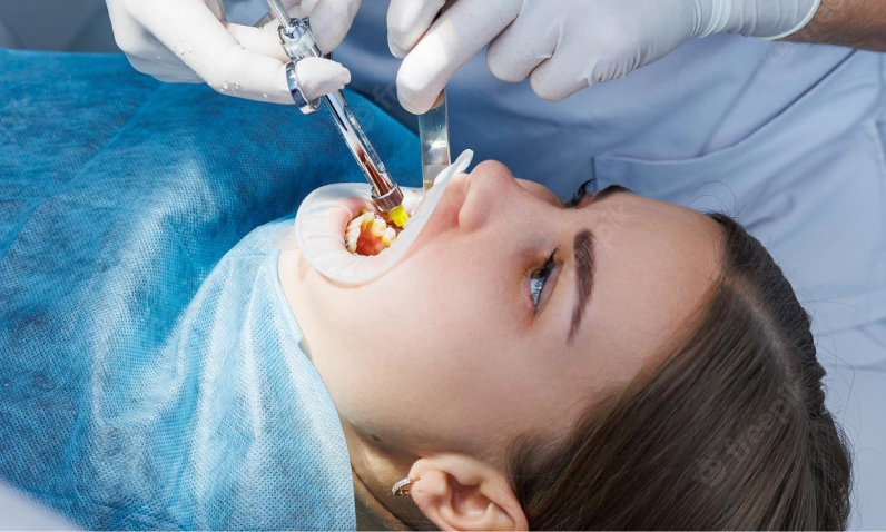 Как лечат кариес в стоматологии - Стоматология HOLIDENT