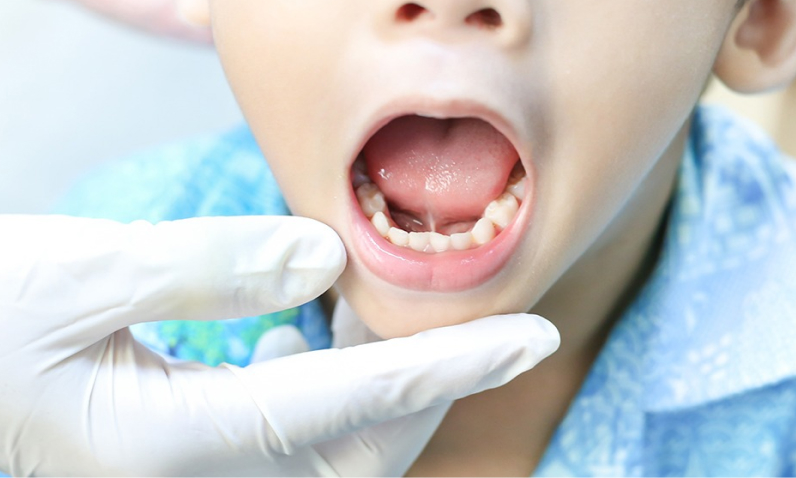 Операция по коррекции уздечки языка или губы в Grand Dent | Grand Dent — семейная стоматология